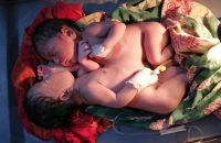 গৌরনদীতে জোড়া লাগানো জমজ কন্যা সন্তানের জন্ম, চিকিৎসার সামর্থ নেই পরিবারের